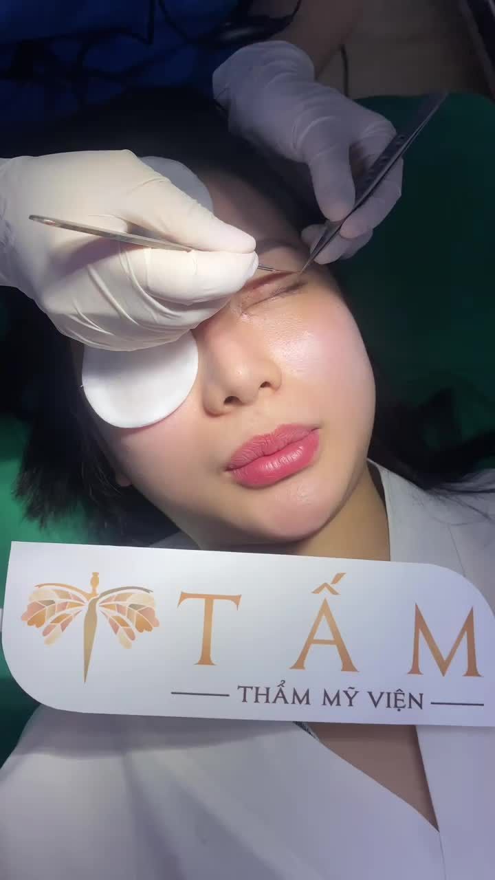 Ngắm nhìn đôi mắt 6 ngày tuổi đến tái khám sau thực hiện dịch vụ Cắt mí + Mở góc mắt tại TMV Tấm!